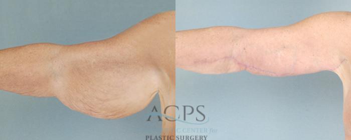 Before & After Liposuction Case 282 Front View: View in Houston, TX