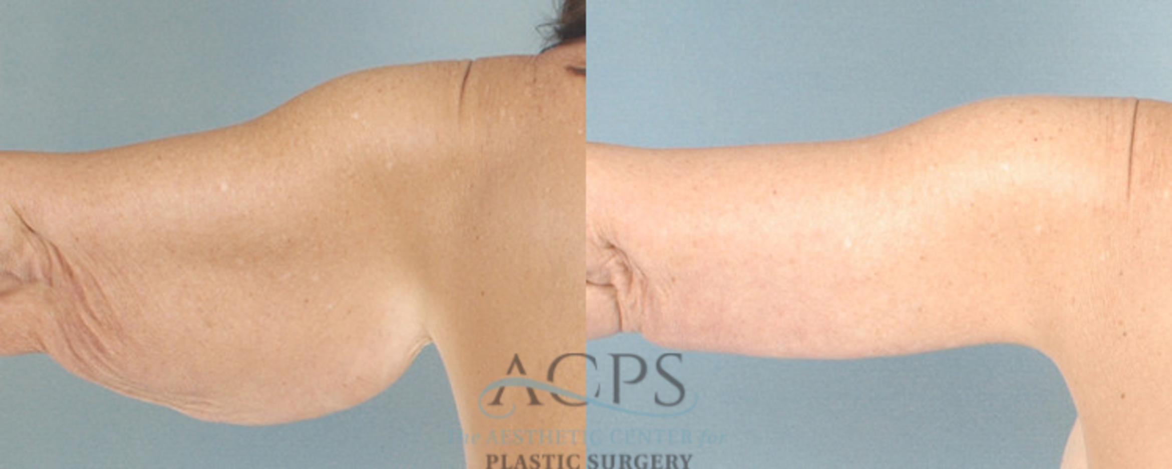 Before & After Liposuction Case 282 Rear View: View in Houston, TX