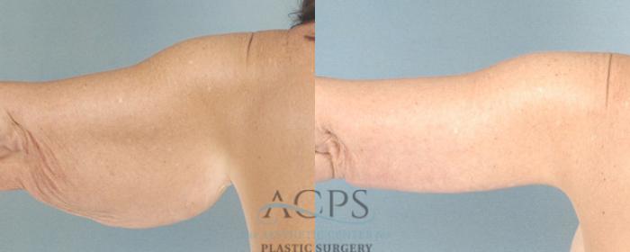 Before & After Liposuction Case 282 Rear View: View in Houston, TX