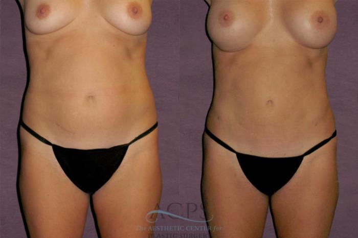 Before & After Liposuction Case 328 Front View: View in Houston, TX