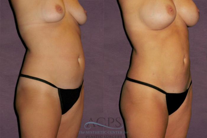 Before & After Liposuction Case 328 Oblique Right View: View in Houston, TX