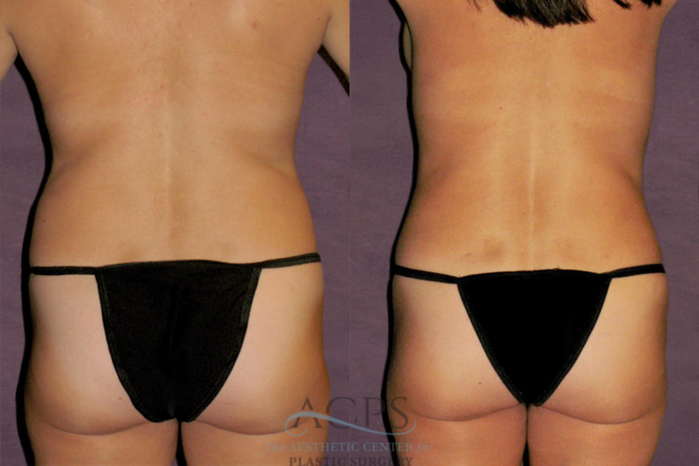 Before & After Liposuction Case 328 Rear View: View in Houston, TX