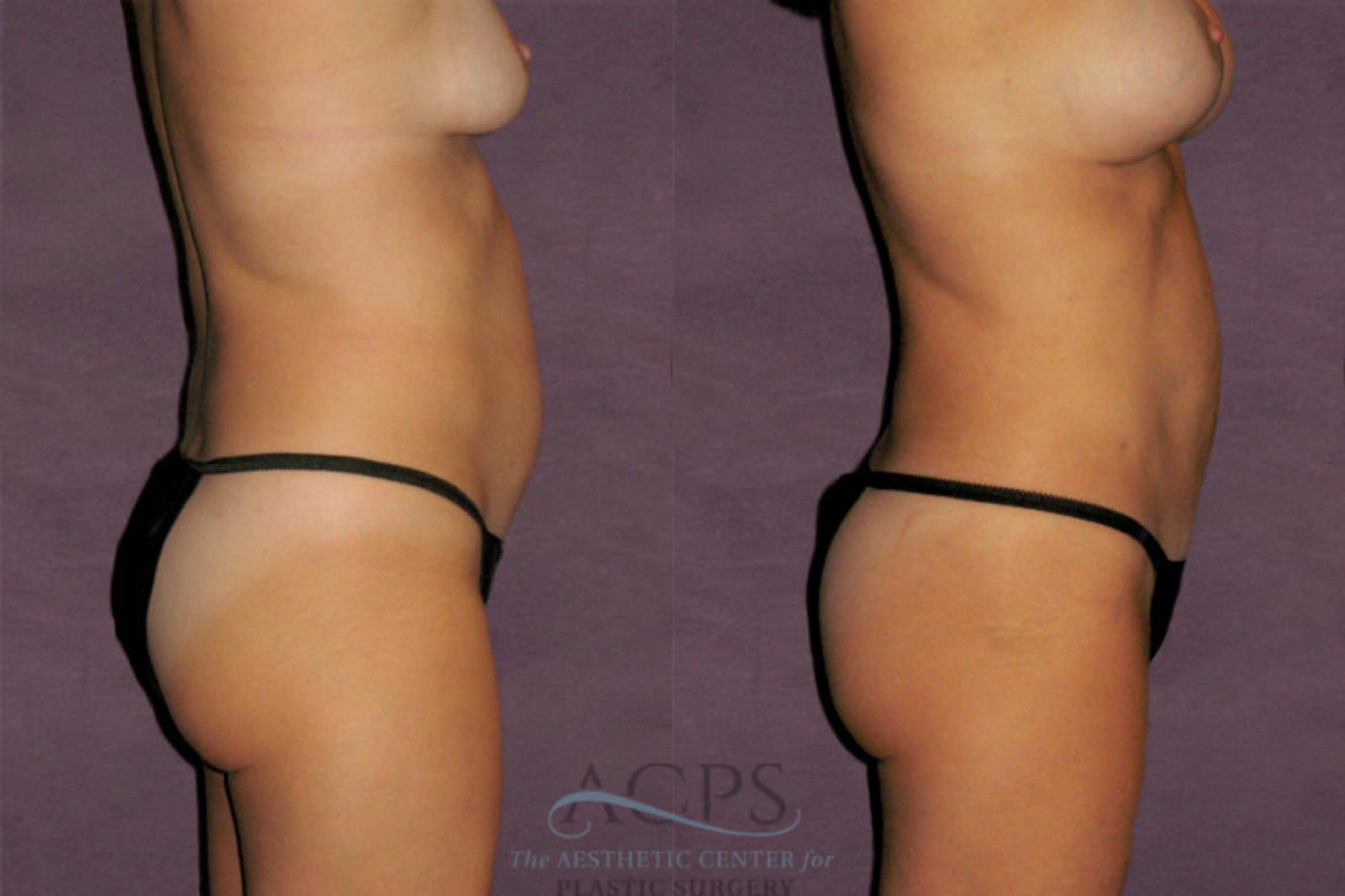 Before & After Liposuction Case 328 Side Right View: View in Houston, TX