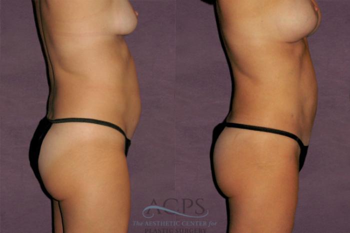Before & After Liposuction Case 328 Side Right View: View in Houston, TX