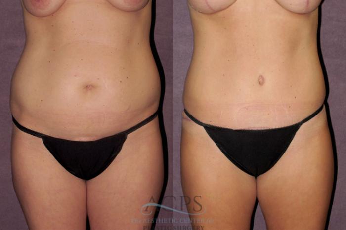 Before & After Mommy Makeover Case 344 Front View: View in Houston, TX