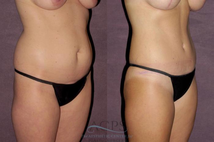 Before & After Mommy Makeover Case 344 Oblique Right View: View in Houston, TX