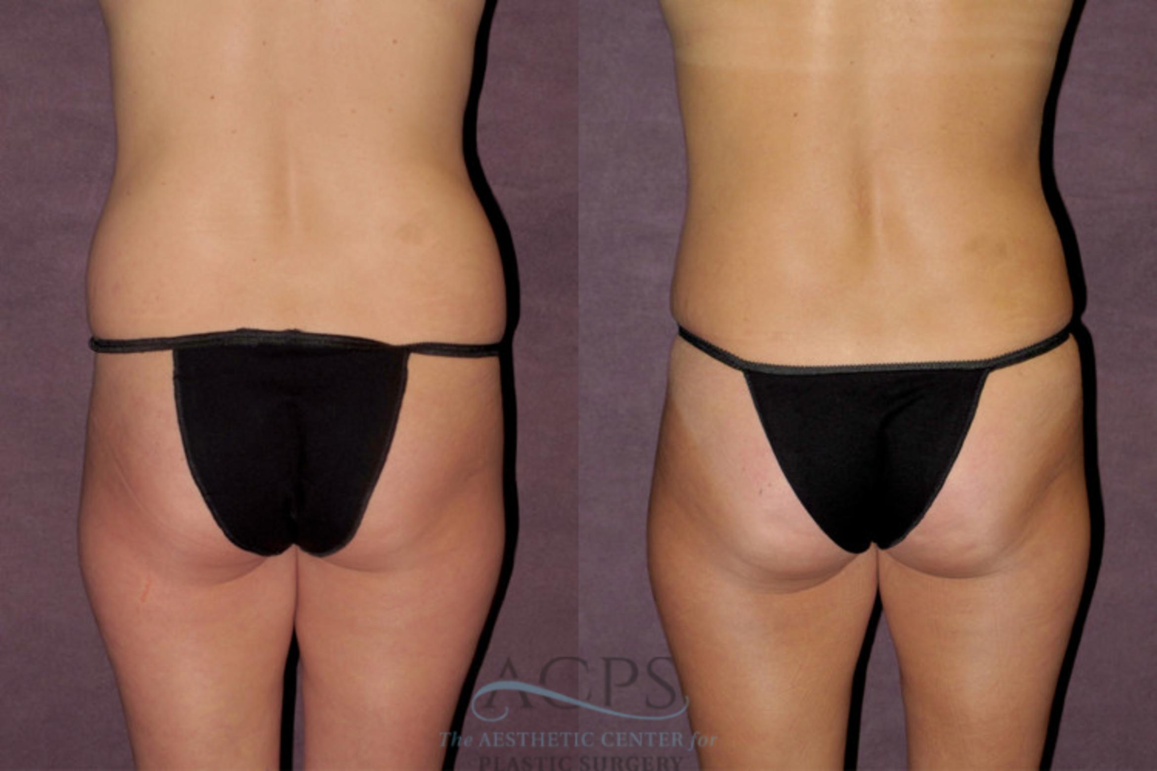 Before & After Mommy Makeover Case 344 Rear View: View in Houston, TX