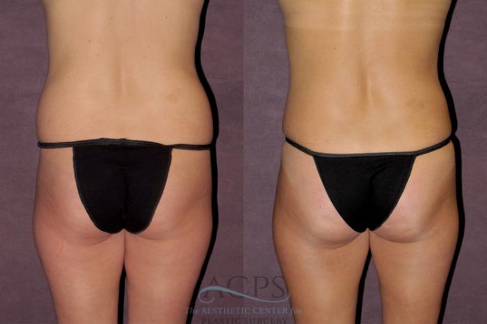 Before & After Mommy Makeover Case 344 Rear View: View in Houston, TX
