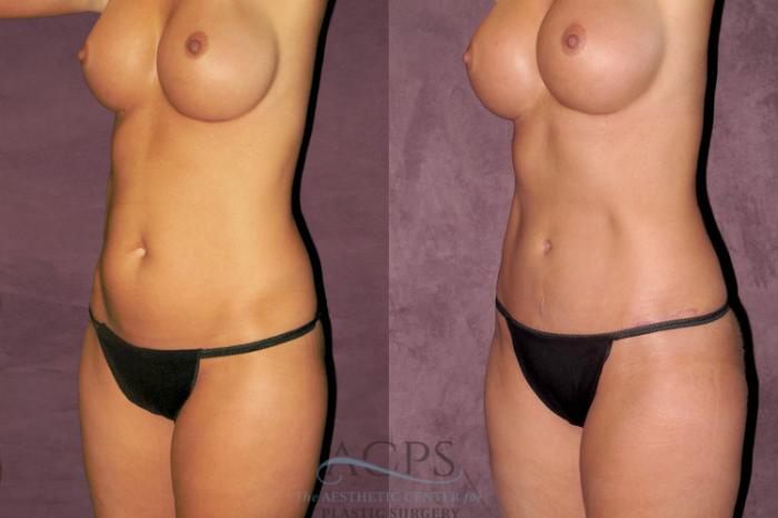 Before & After Liposuction Case 345 Oblique Left View: View in Houston, TX