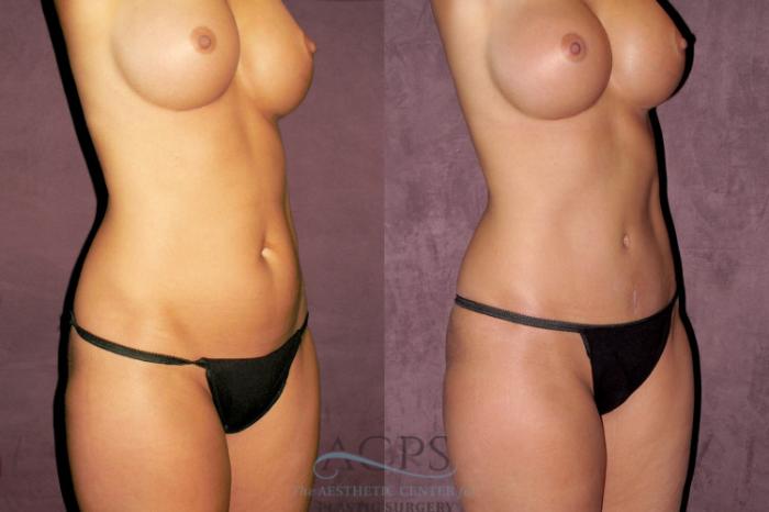 Before & After Liposuction Case 345 Oblique Right View: View in Houston, TX