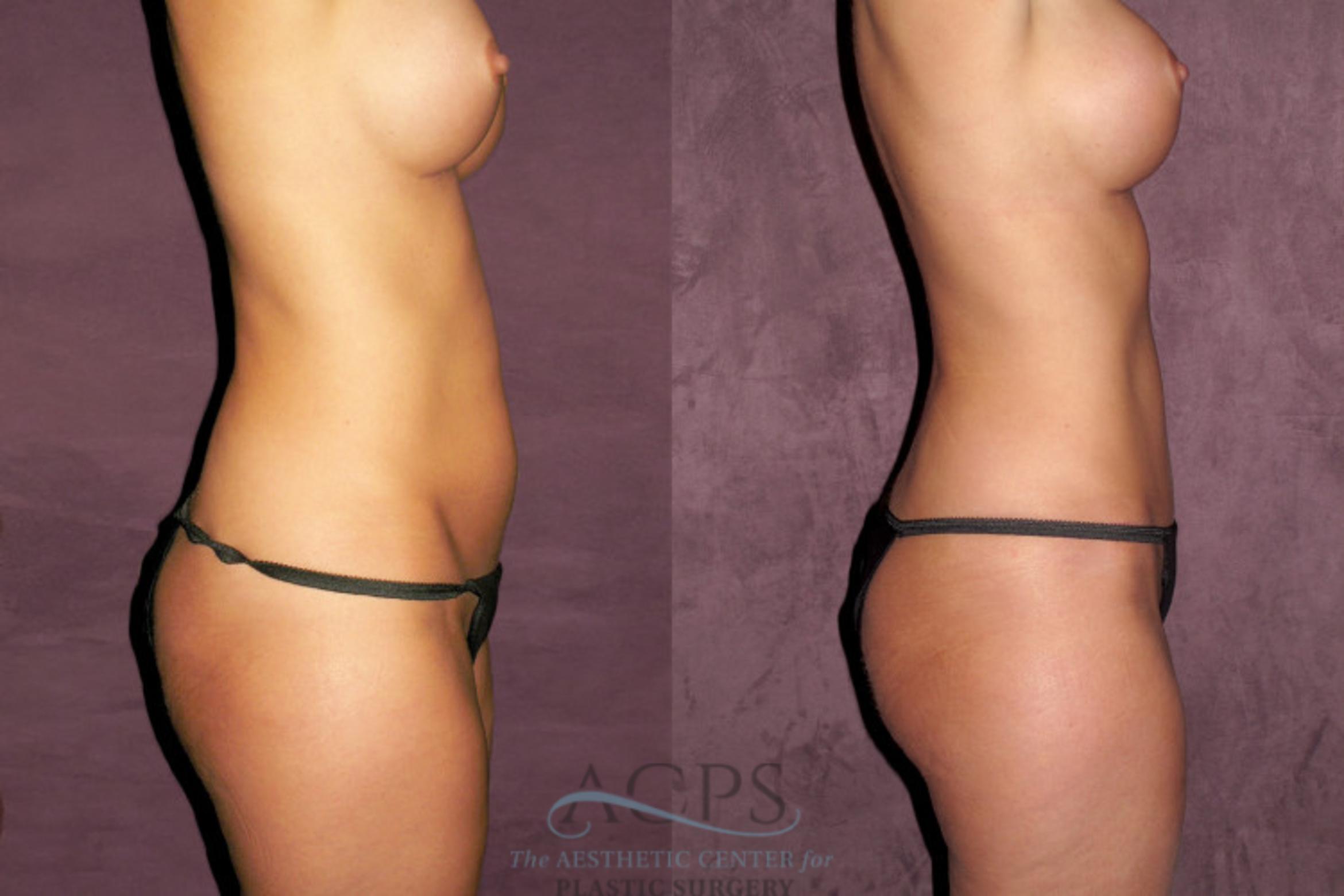 Before & After Liposuction Case 345 Side Right View: View in Houston, TX