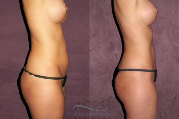 Before & After Liposuction Case 345 Side Right View: View in Houston, TX