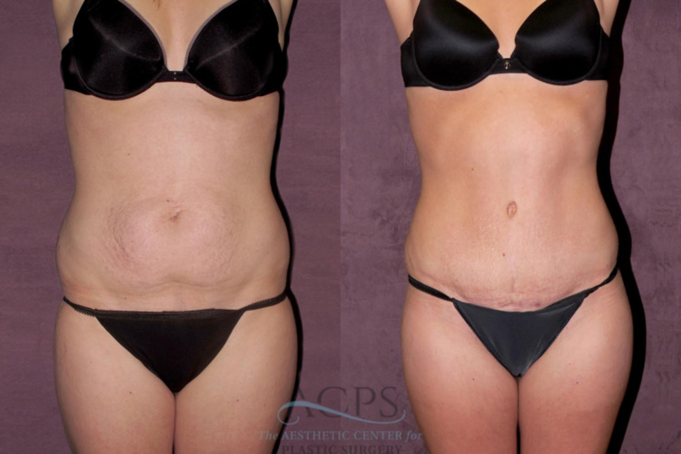 Before & After Liposuction Case 346 Front View: View in Houston, TX