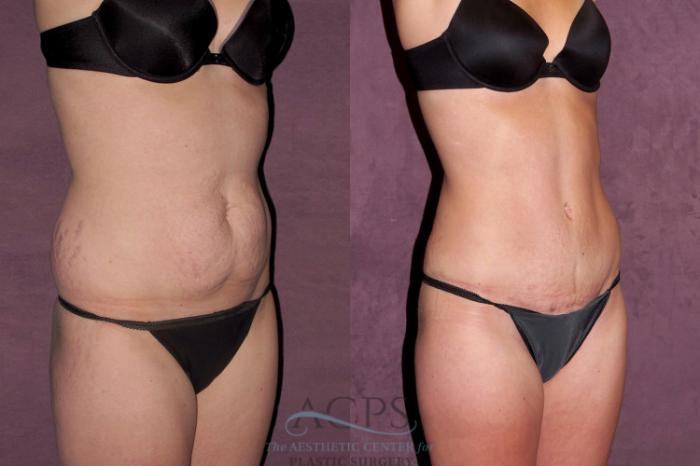 Before & After Liposuction Case 346 Oblique Right View: View in Houston, TX