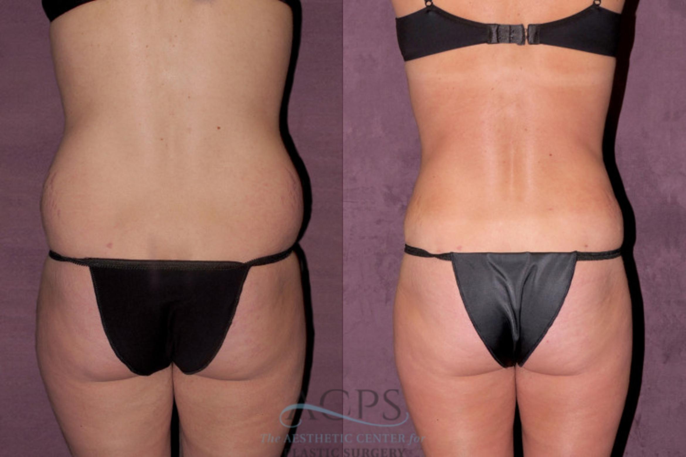 Before & After Liposuction Case 346 Rear View: View in Houston, TX