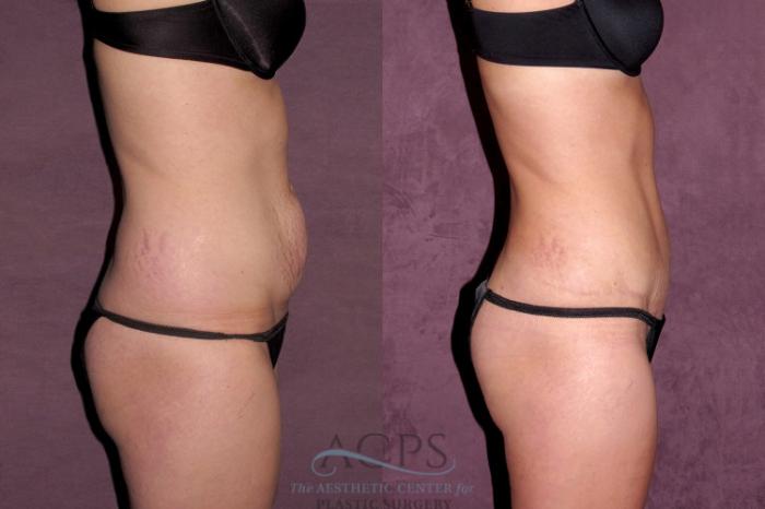 Before & After Liposuction Case 346 Side View: View in Houston, TX