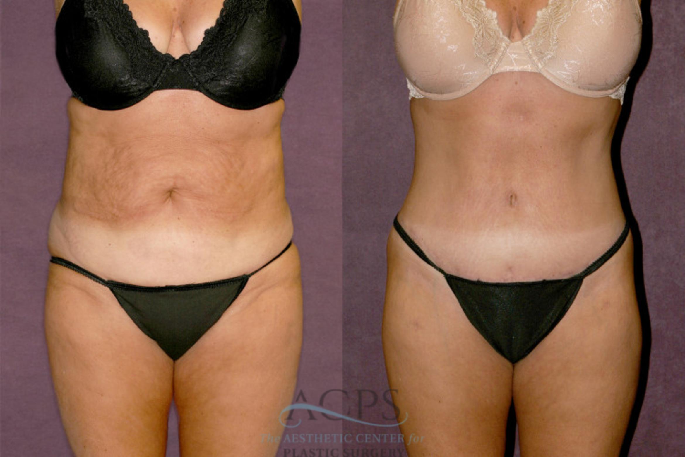 Before & After Body Lift Case 347 Front View: View in Houston, TX