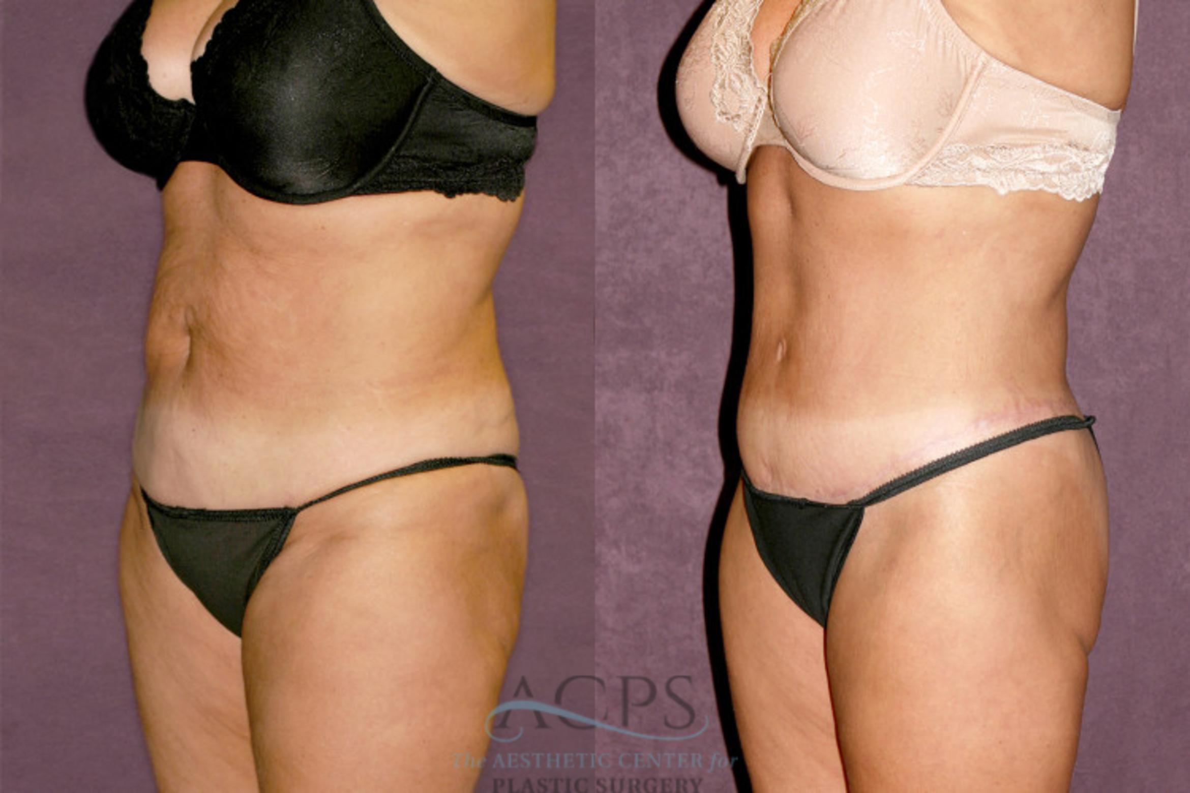 Before & After Body Lift Case 347 Oblique Left View: View in Houston, TX