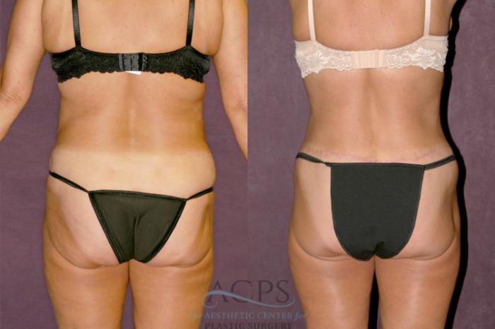 Before & After Body Lift Case 347 Rear View: View in Houston, TX