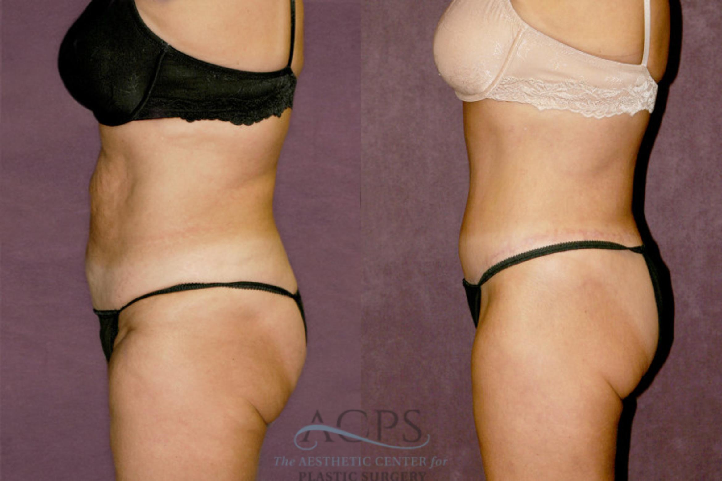 Before & After Body Lift Case 347 Side Left View: View in Houston, TX