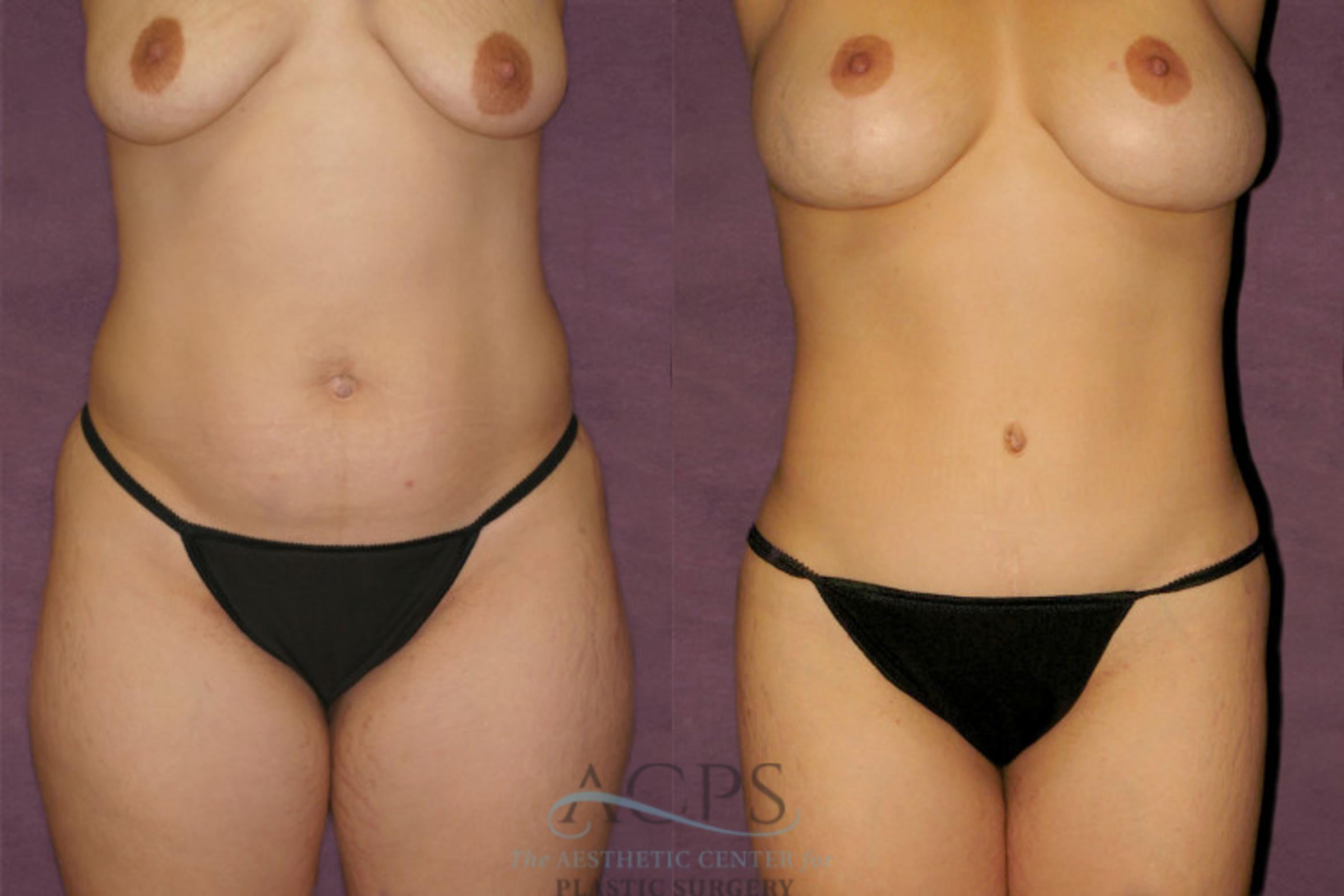 Before & After Liposuction Case 348 Front View: View in Houston, TX