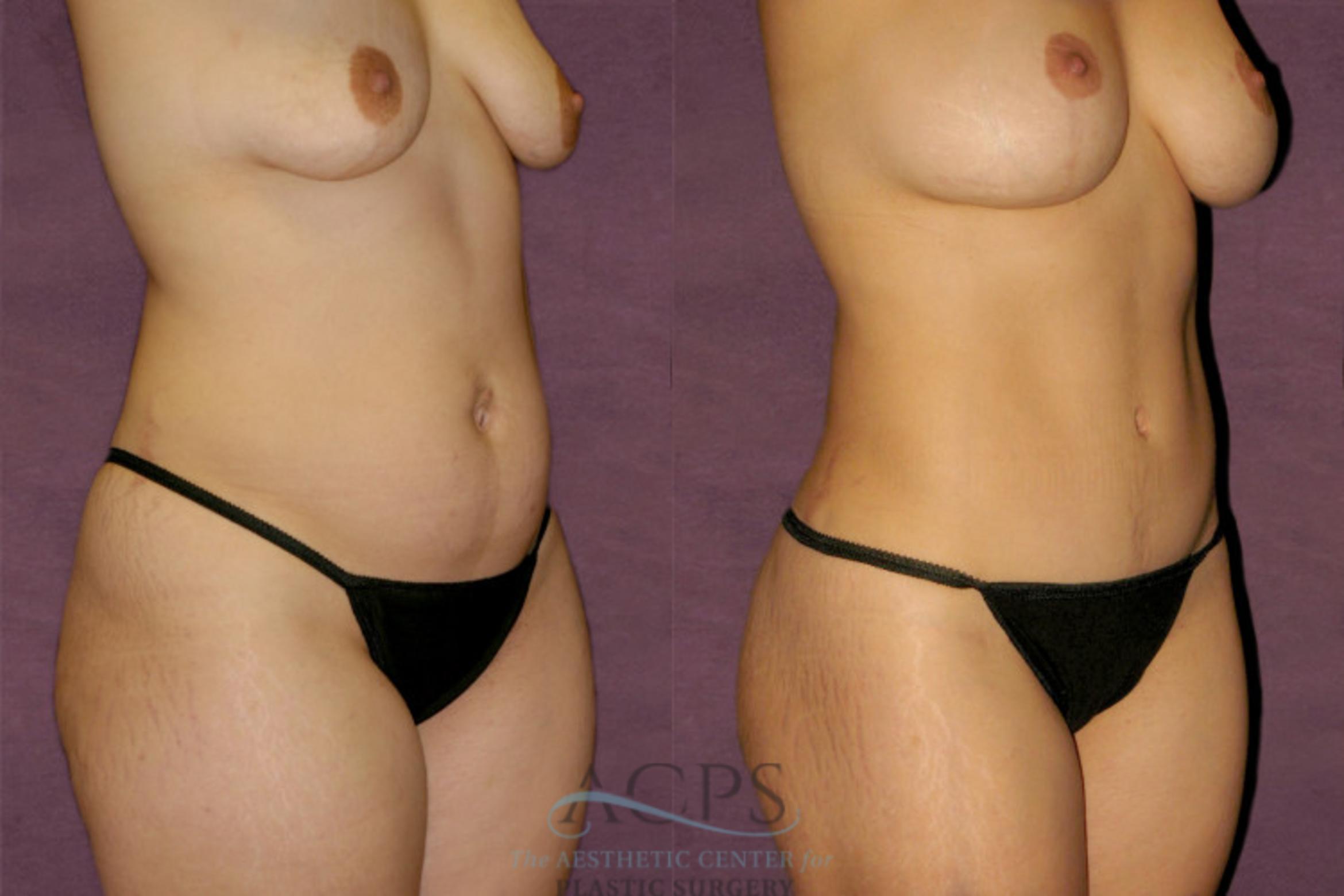 Before & After Liposuction Case 348 Oblique Right View: View in Houston, TX