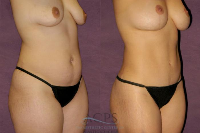Before & After Liposuction Case 348 Oblique Right View: View in Houston, TX