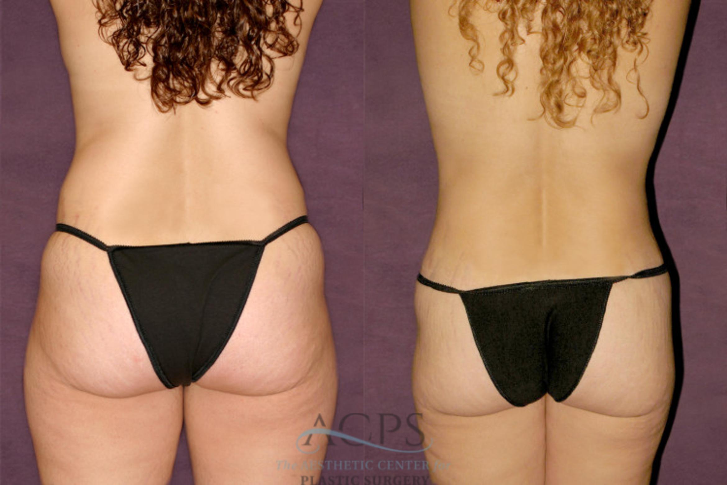 Before & After Liposuction Case 348 Rear View: View in Houston, TX