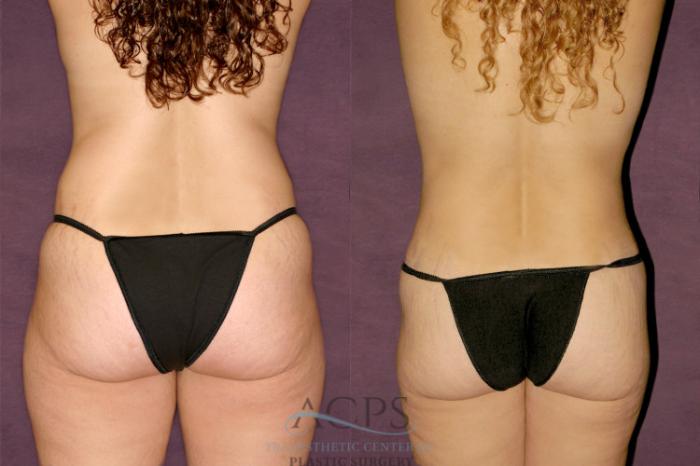 Before & After Liposuction Case 348 Rear View: View in Houston, TX
