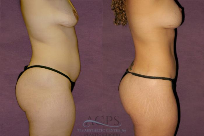Before & After Liposuction Case 348 Side Right View: View in Houston, TX