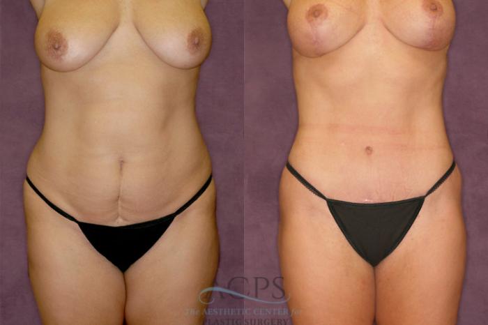 Before & After Liposuction Case 349 Front View: View in Houston, TX