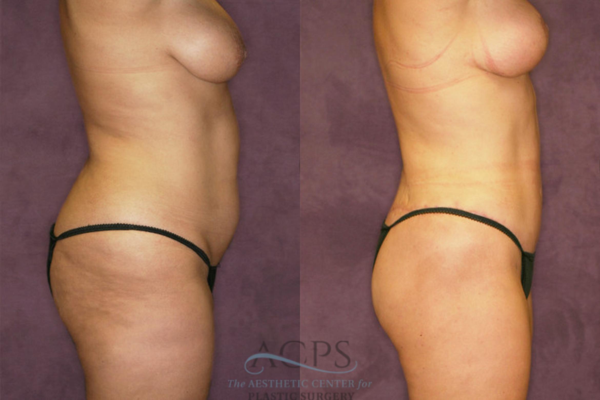 Before & After Liposuction Case 349 Oblique Right View: View in Houston, TX
