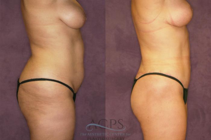 Before & After Liposuction Case 349 Oblique Right View: View in Houston, TX