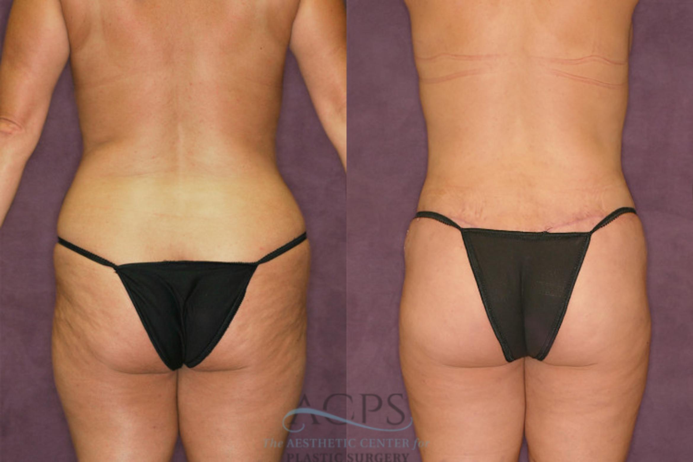 Before & After Liposuction Case 349 Rear View: View in Houston, TX