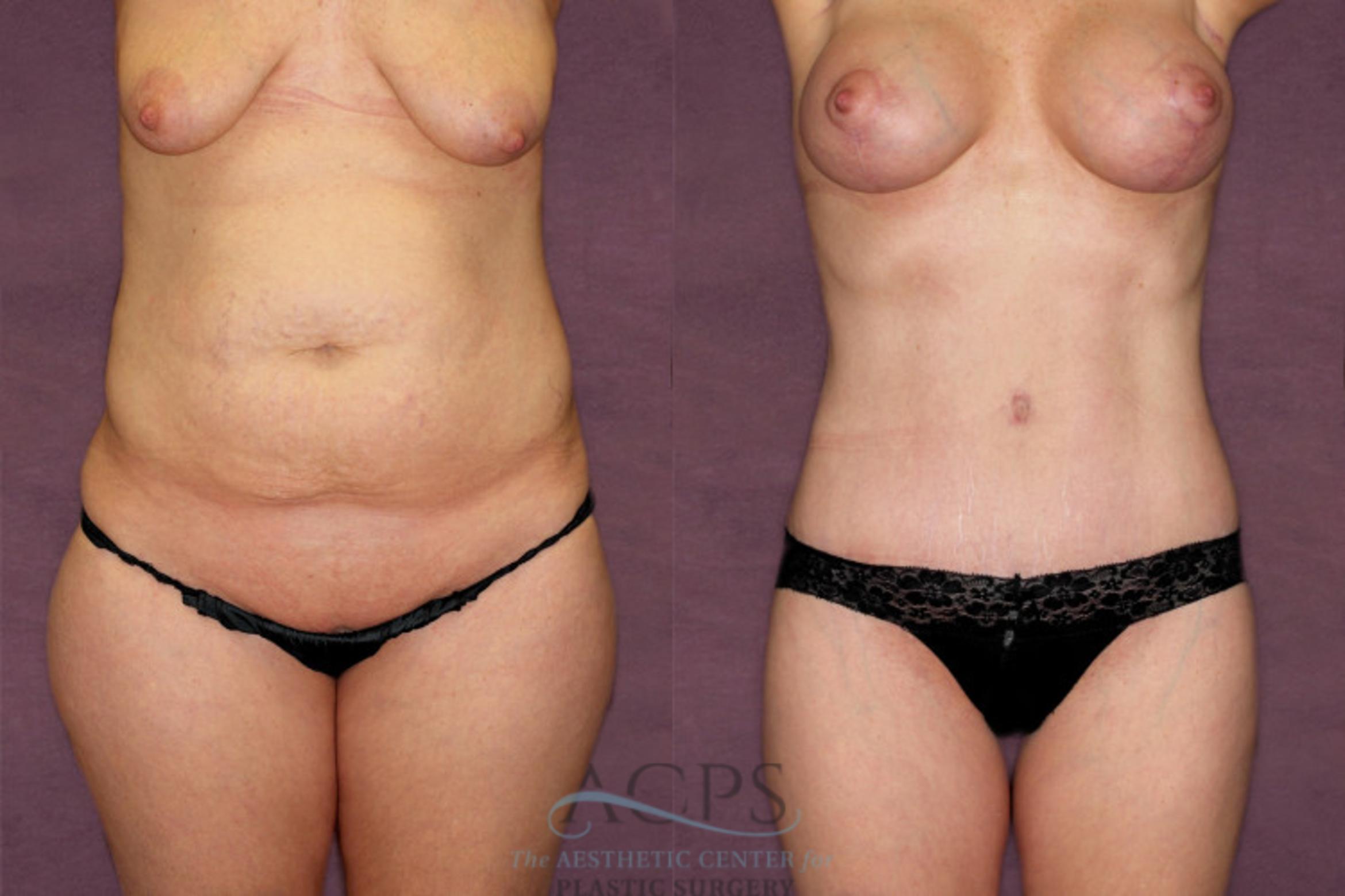 Before & After Liposuction Case 350 Front View: View in Houston, TX