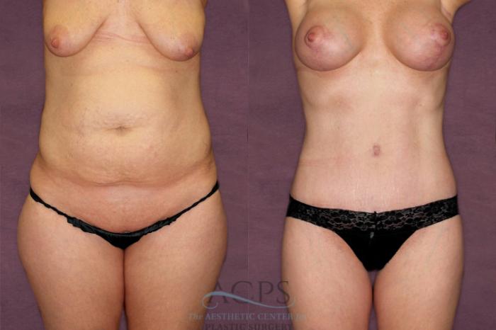 Before & After Liposuction Case 350 Front View: View in Houston, TX