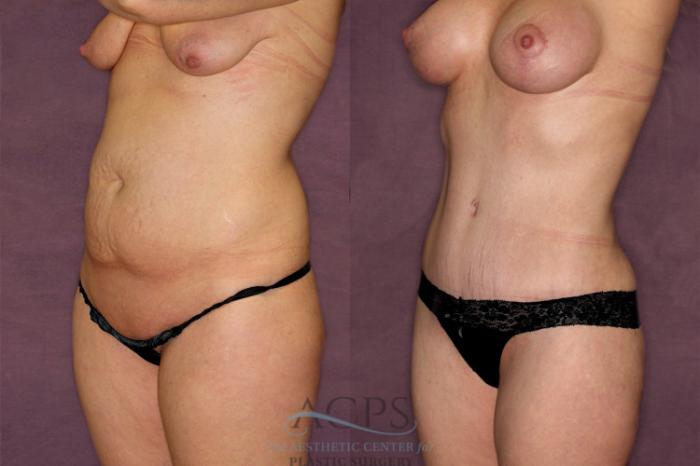 Before & After Liposuction Case 350 Oblique Left View: View in Houston, TX
