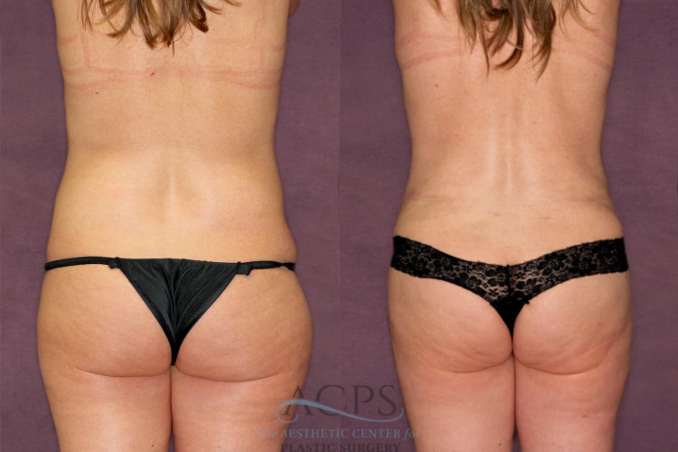 Before & After Liposuction Case 350 Rear View: View in Houston, TX