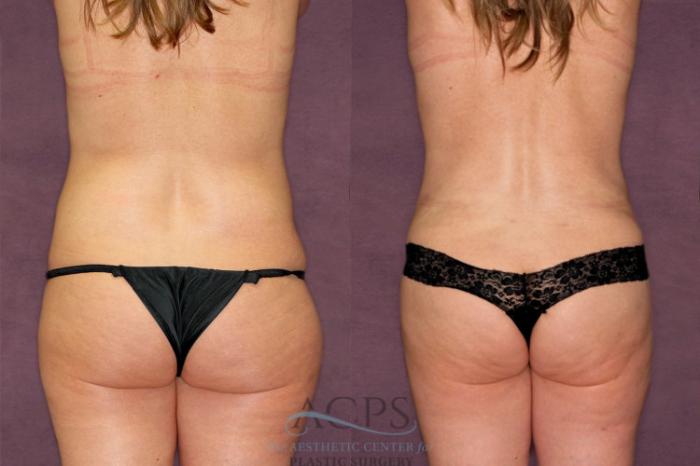 Before & After Liposuction Case 350 Rear View: View in Houston, TX