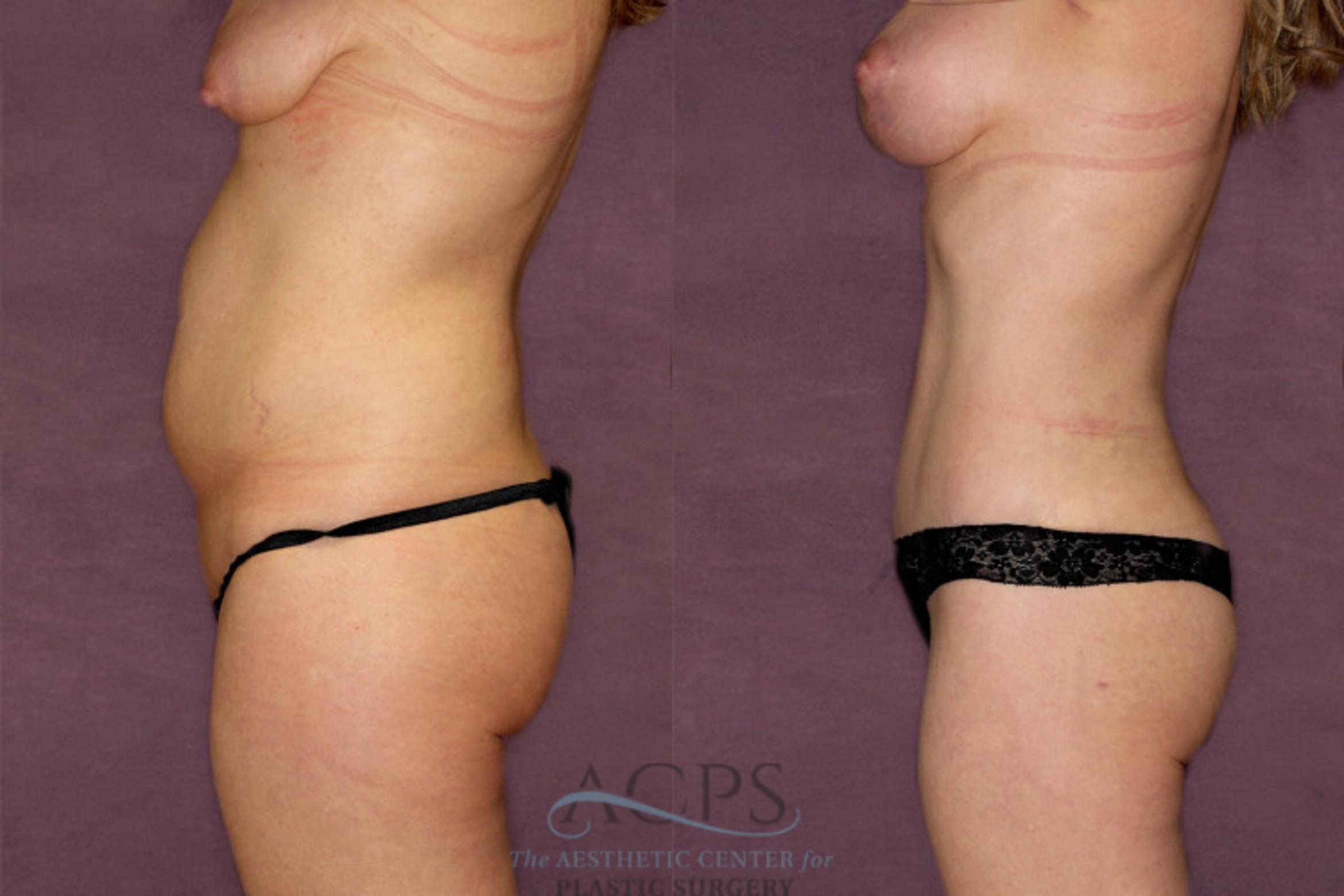 Before & After Liposuction Case 350 Side Left View: View in Houston, TX