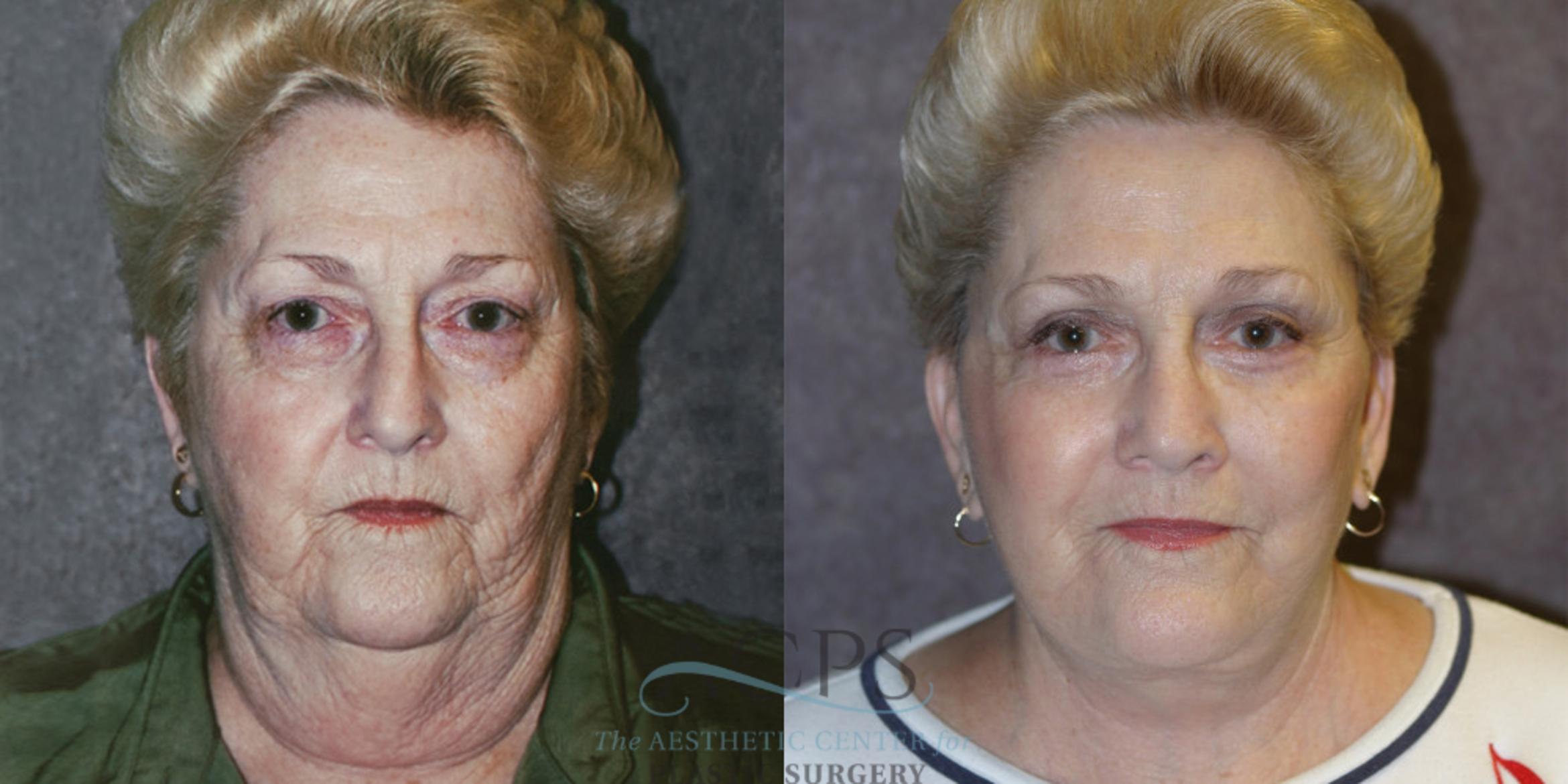 Before & After Neck Lift Case 359 Front View: View in Houston, TX