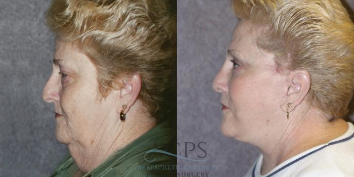 Before & After Neck Lift Case 359 Oblique Left View: View in Houston, TX