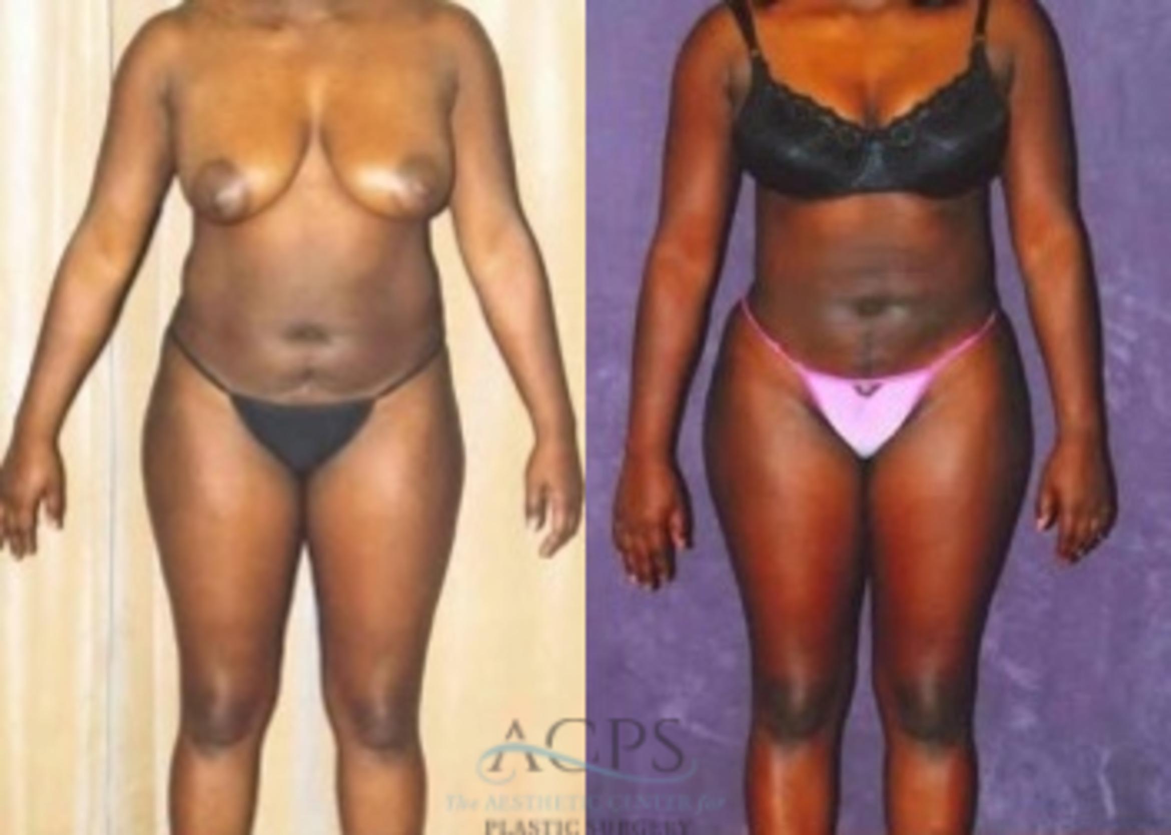 Before & After Liposuction Case 375 Front View: View in Houston, TX