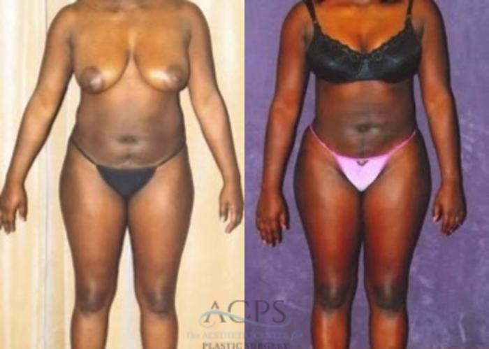 Before & After Liposuction Case 375 Front View: View in Houston, TX
