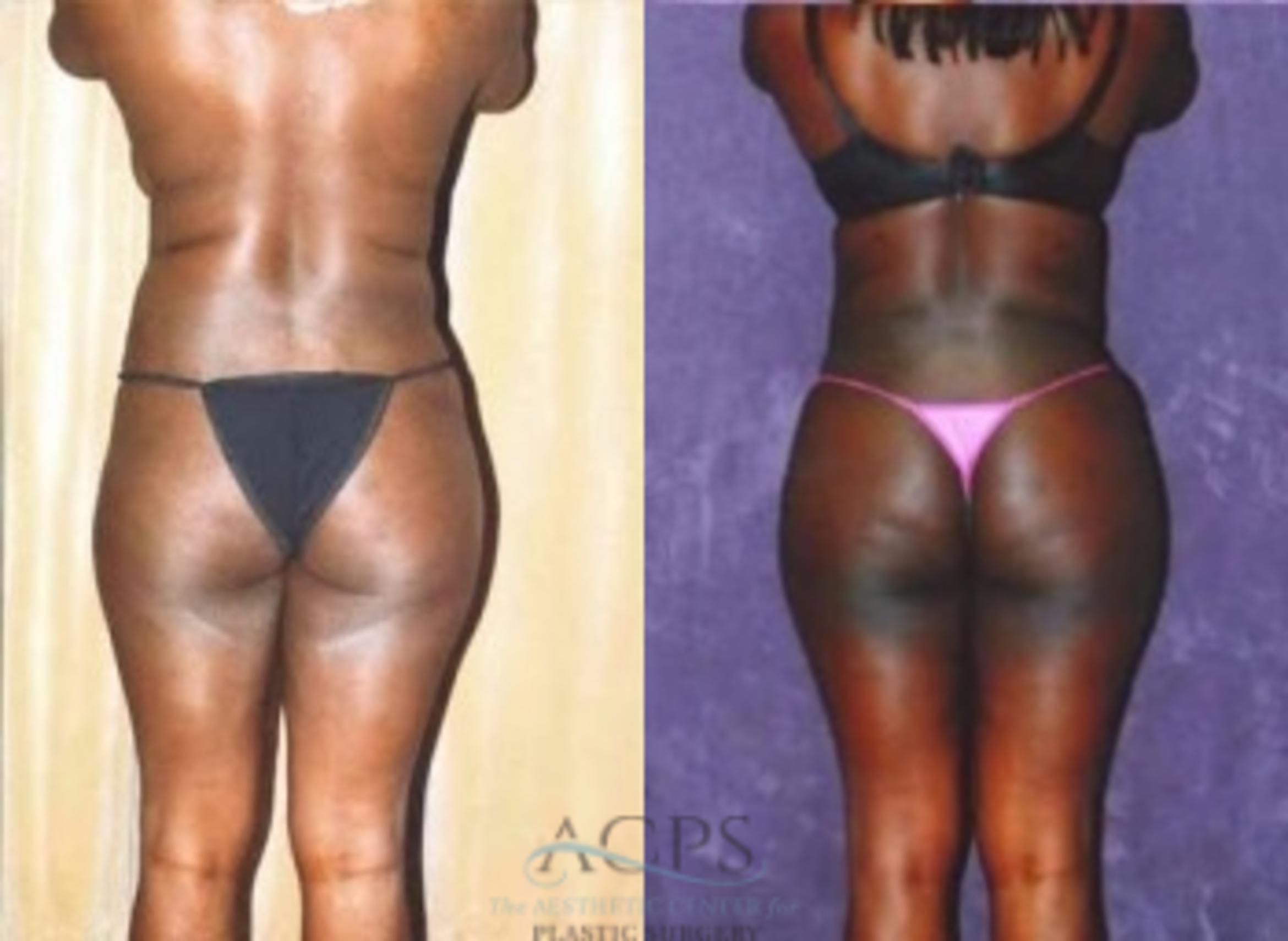 Before & After Liposuction Case 375 Rear View: View in Houston, TX