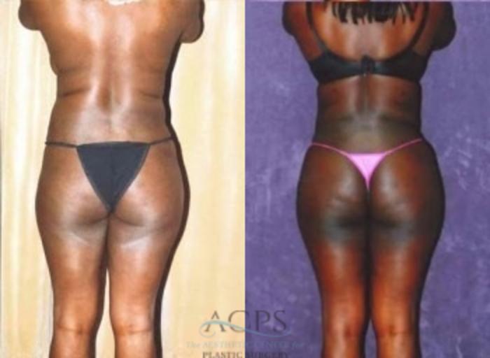 Before & After Liposuction Case 375 Rear View: View in Houston, TX