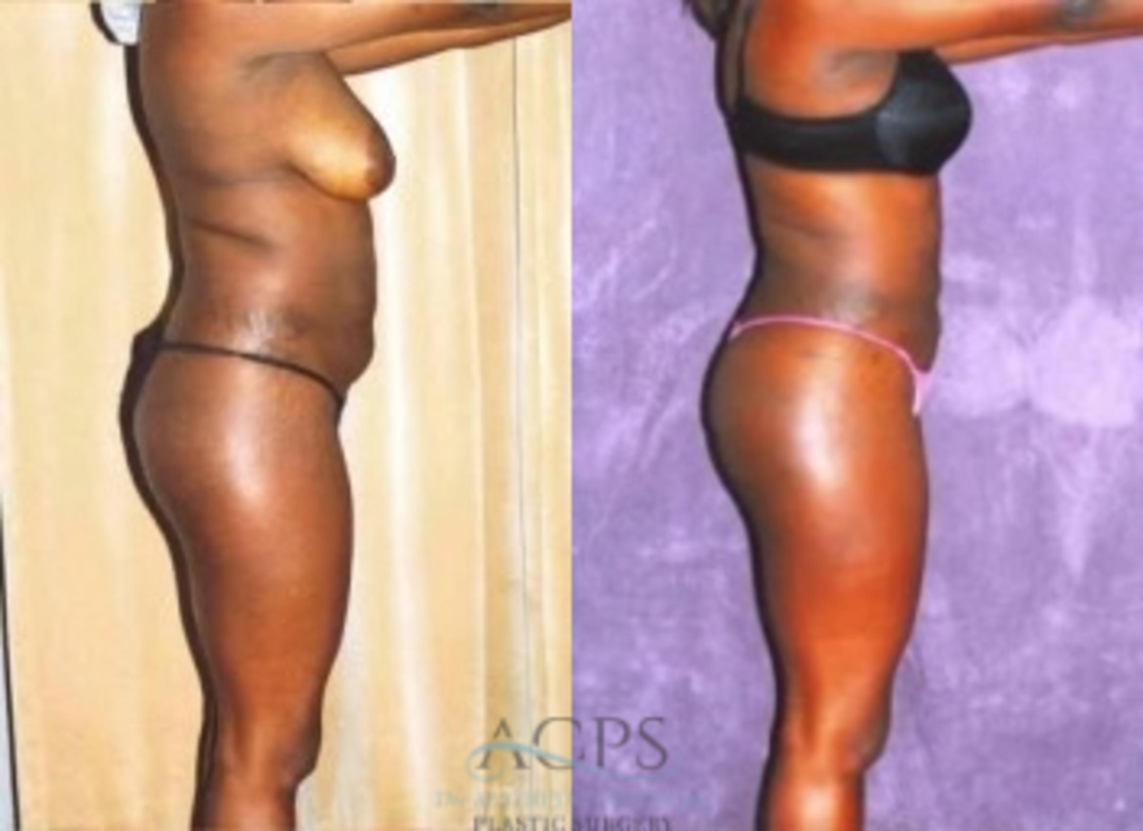 Before & After Liposuction Case 375 Side View: View in Houston, TX