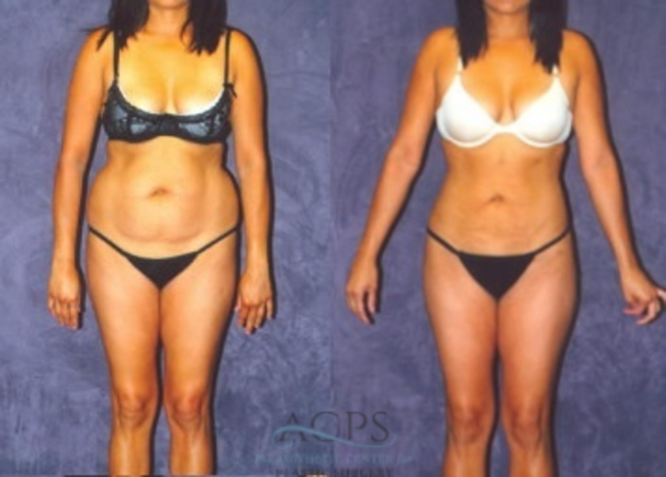 Before & After Liposuction Case 376 Front View: View in Houston, TX