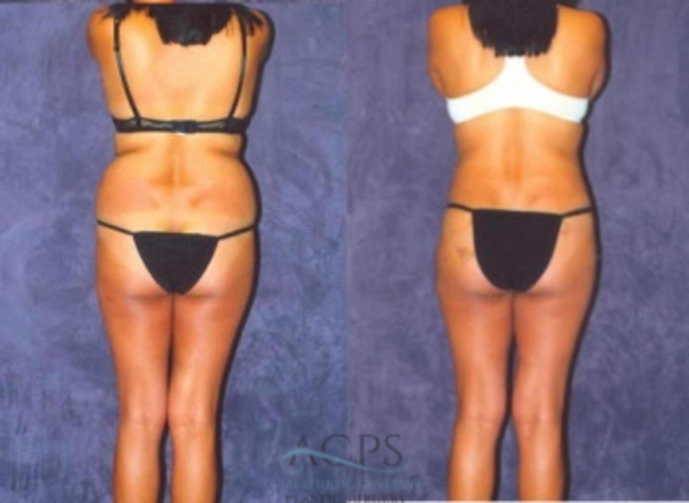Before & After Liposuction Case 376 Rear View: View in Houston, TX