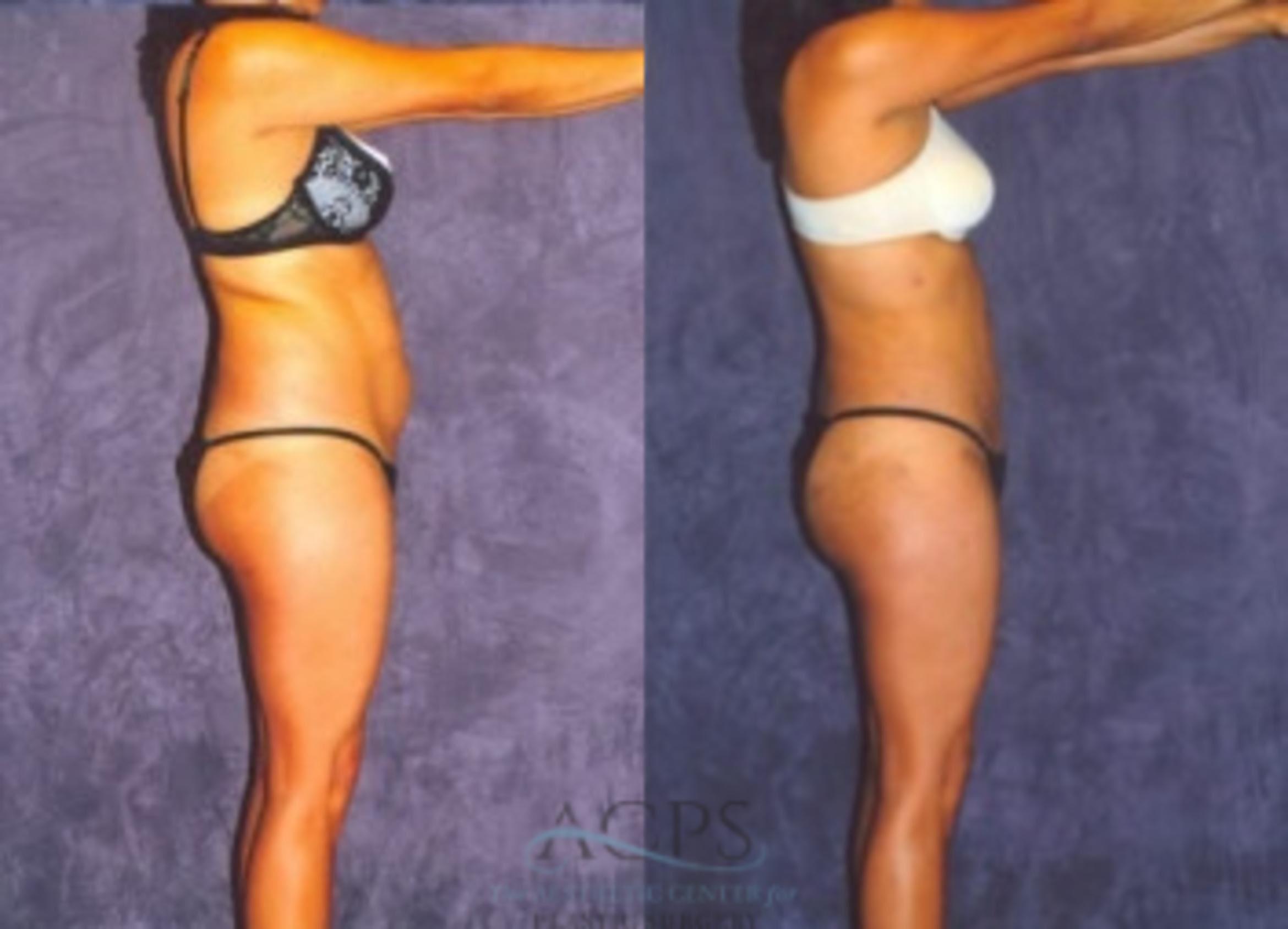 Before & After Liposuction Case 376 Side View: View in Houston, TX